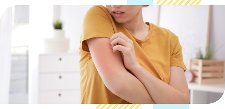 A woman wearing light mustard color clothing scratches her hand. Her hands show signs of redness and itchiness.